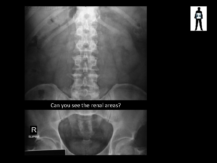 Can you see the renal areas? 