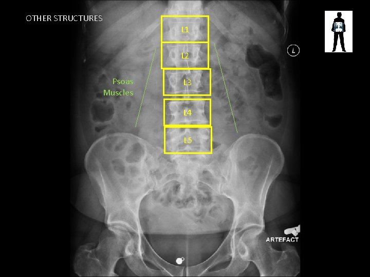 OTHER STRUCTURES L 1 L 2 Psoas Muscles L 3 L 4 L 5