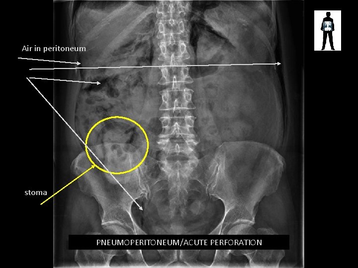 Air in peritoneum stoma PNEUMOPERITONEUM/ACUTE PERFORATION 