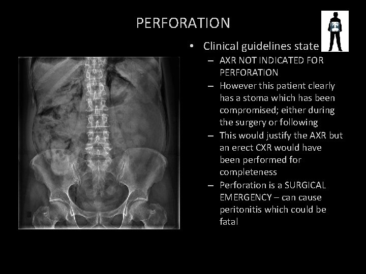 PERFORATION • Clinical guidelines state – AXR NOT INDICATED FOR PERFORATION – However this