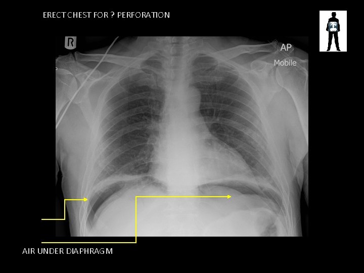 ERECT CHEST FOR ? PERFORATION AIR UNDER DIAPHRAGM 