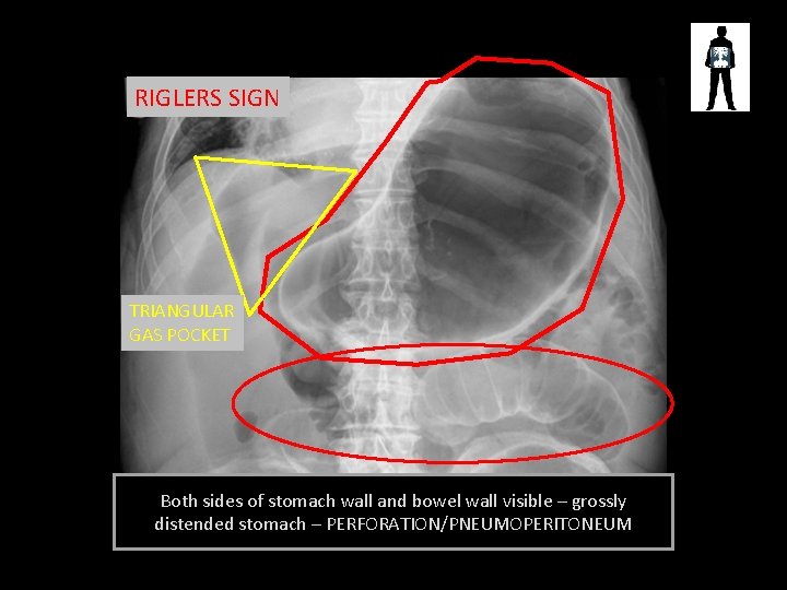 RIGLERS SIGN TRIANGULAR GAS POCKET Both sides of stomach wall and bowel wall visible