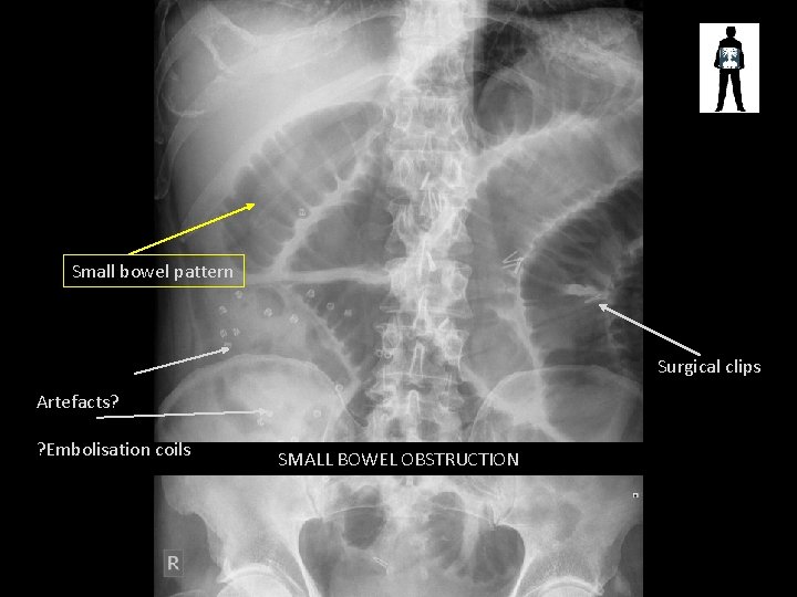Small bowel pattern Surgical clips Artefacts? ? Embolisation coils SMALL BOWEL OBSTRUCTION 