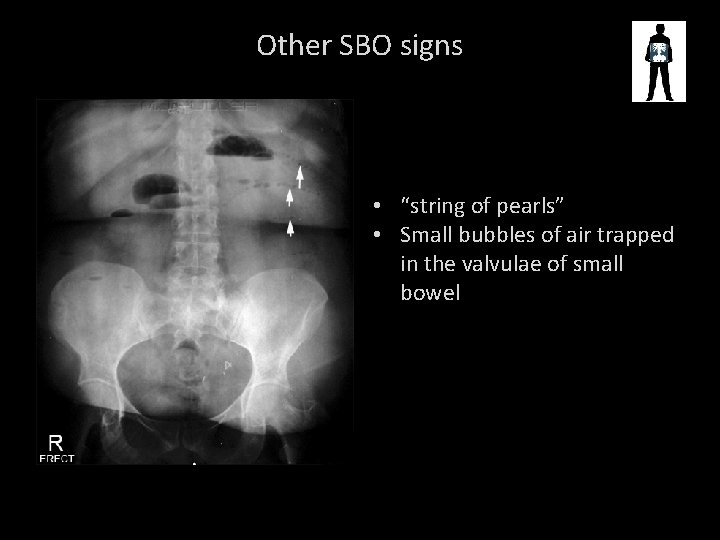 Other SBO signs • “string of pearls” • Small bubbles of air trapped in