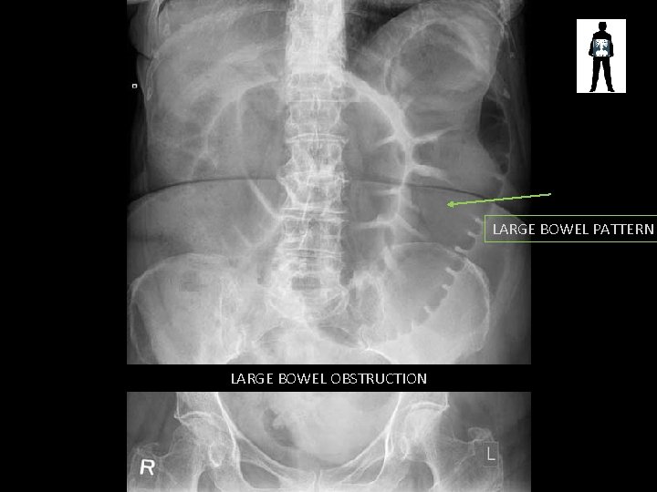 LARGE BOWEL PATTERN LARGE BOWEL OBSTRUCTION 
