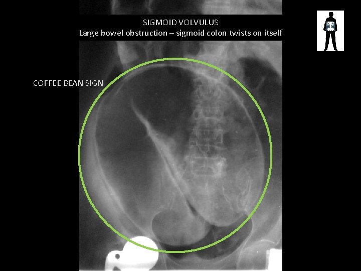 SIGMOID VOLVULUS Large bowel obstruction – sigmoid colon twists on itself COFFEE BEAN SIGN