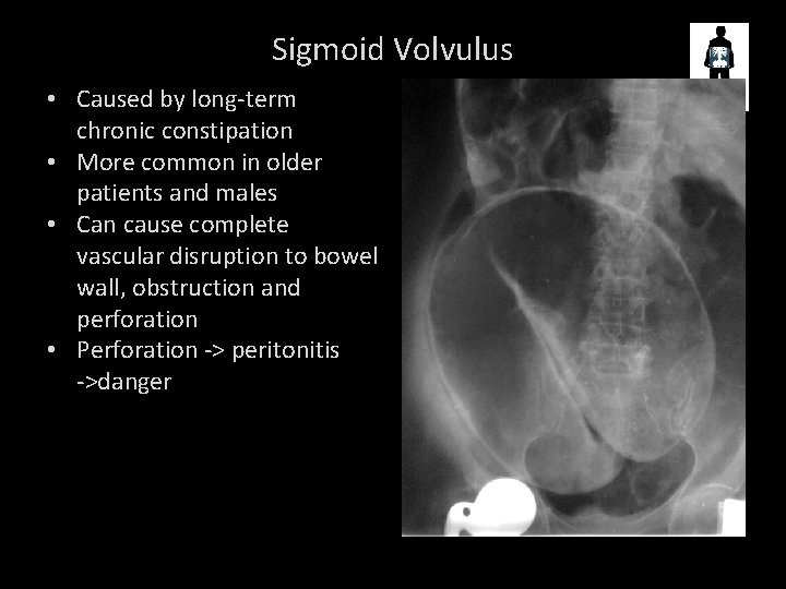 Sigmoid Volvulus • Caused by long-term chronic constipation • More common in older patients