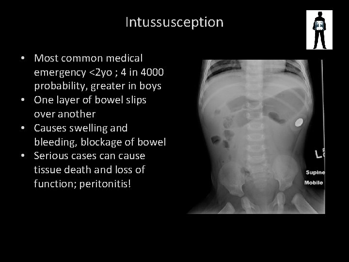 Intussusception • Most common medical emergency <2 yo ; 4 in 4000 probability, greater