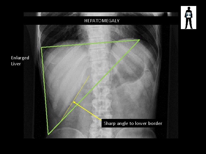 HEPATOMEGALY Enlarged Liver Sharp angle to lower border 