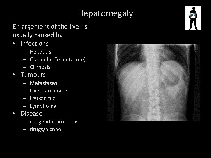 Hepatomegaly Enlargement of the liver is usually caused by • Infections – Hepatitis –
