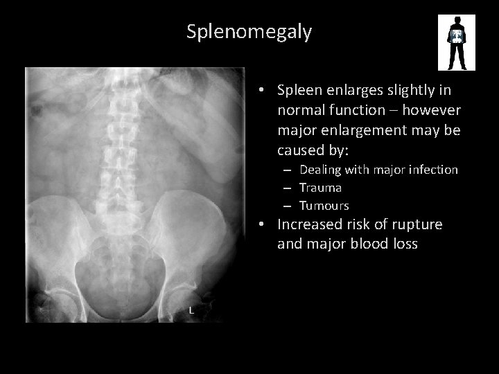 Splenomegaly • Spleen enlarges slightly in normal function – however major enlargement may be