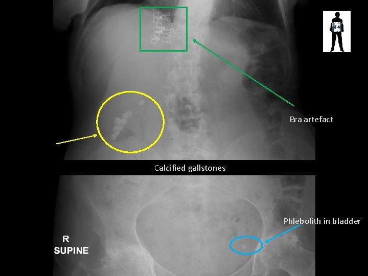 Bra artefact Calcified gallstones Phlebolith in bladder 