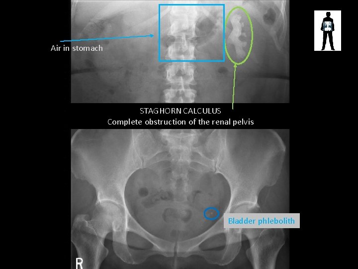 Air in stomach STAGHORN CALCULUS Complete obstruction of the renal pelvis Bladder phlebolith 