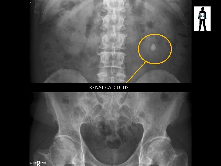 RENAL CALCULUS 