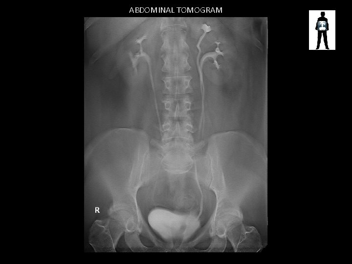 ABDOMINAL TOMOGRAM 