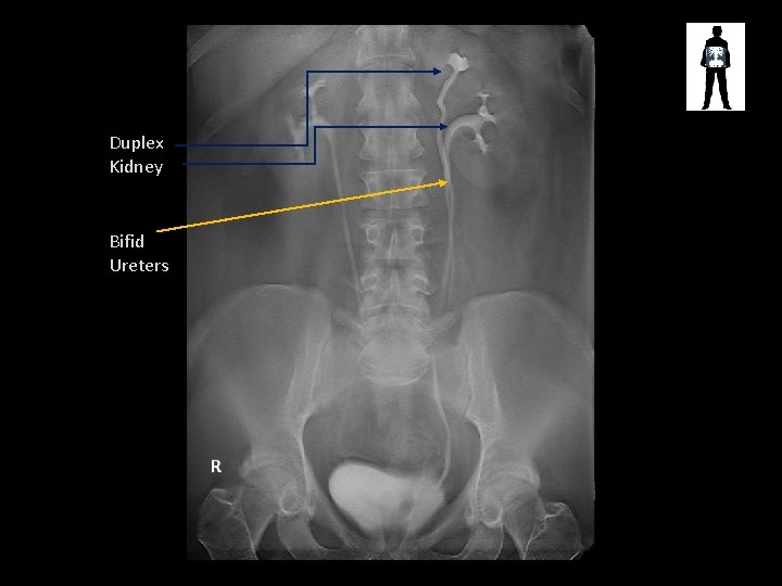 Duplex Kidney Bifid Ureters 