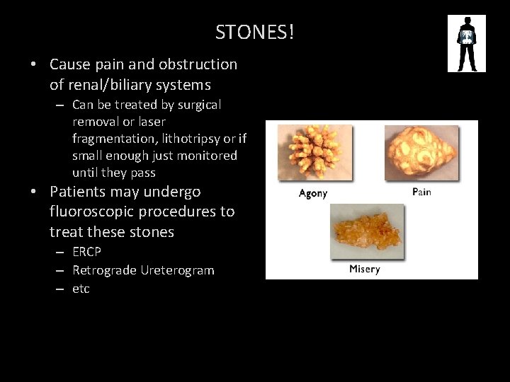 STONES! • Cause pain and obstruction of renal/biliary systems – Can be treated by