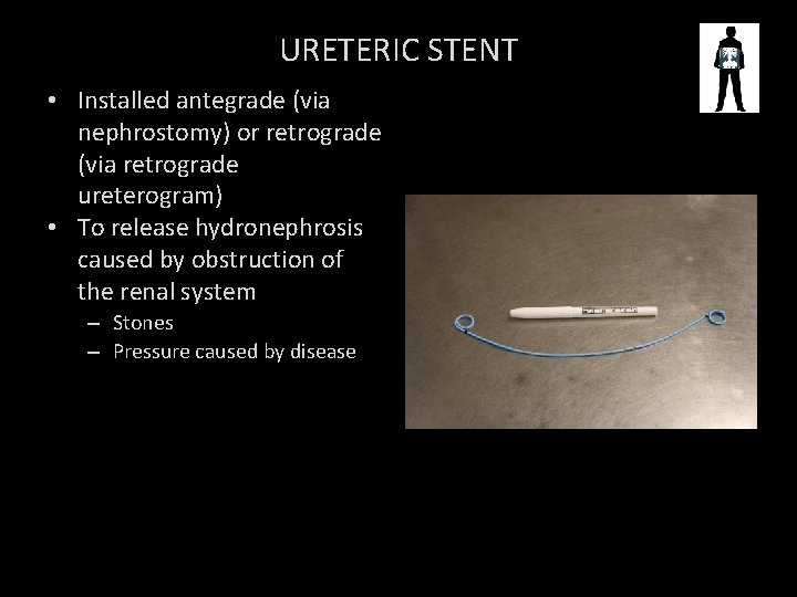 URETERIC STENT • Installed antegrade (via nephrostomy) or retrograde (via retrograde ureterogram) • To
