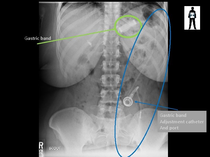 Gastric band Adjustment catheter And port 