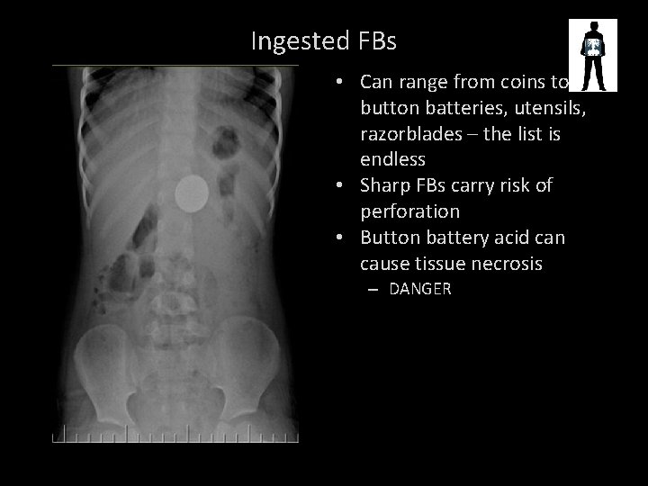 Ingested FBs • Can range from coins to button batteries, utensils, razorblades – the