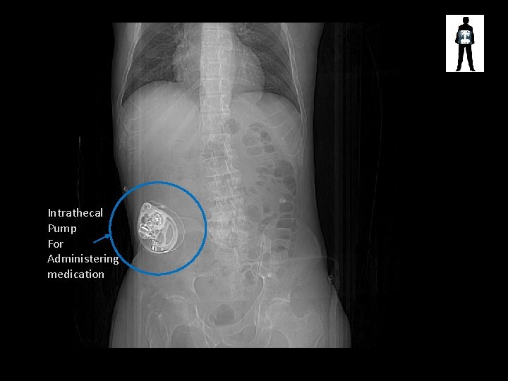 Intrathecal Pump For Administering medication 