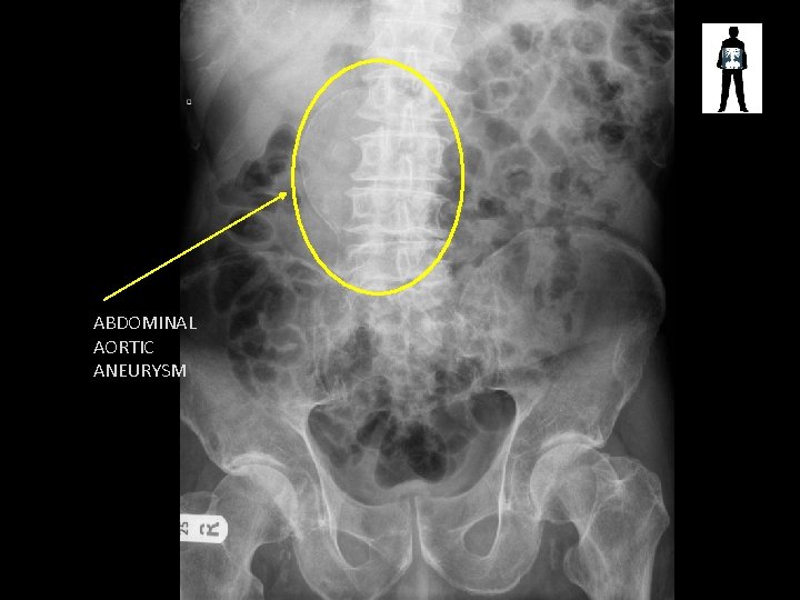 ABDOMINAL AORTIC ANEURYSM 