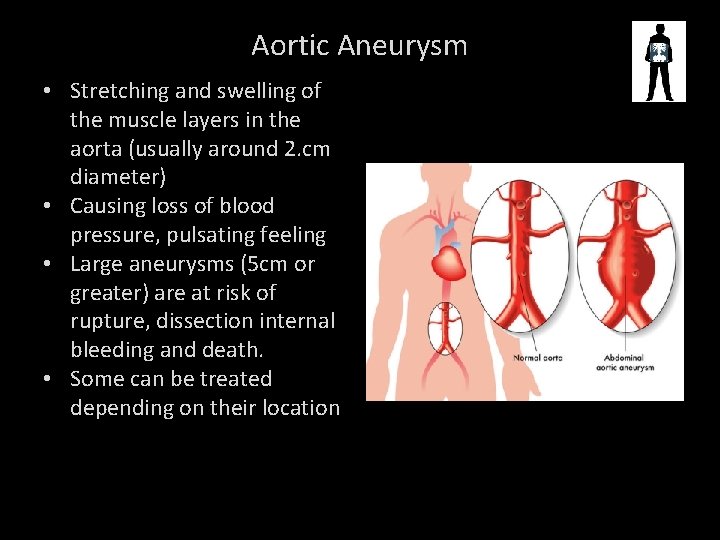 Aortic Aneurysm • Stretching and swelling of the muscle layers in the aorta (usually