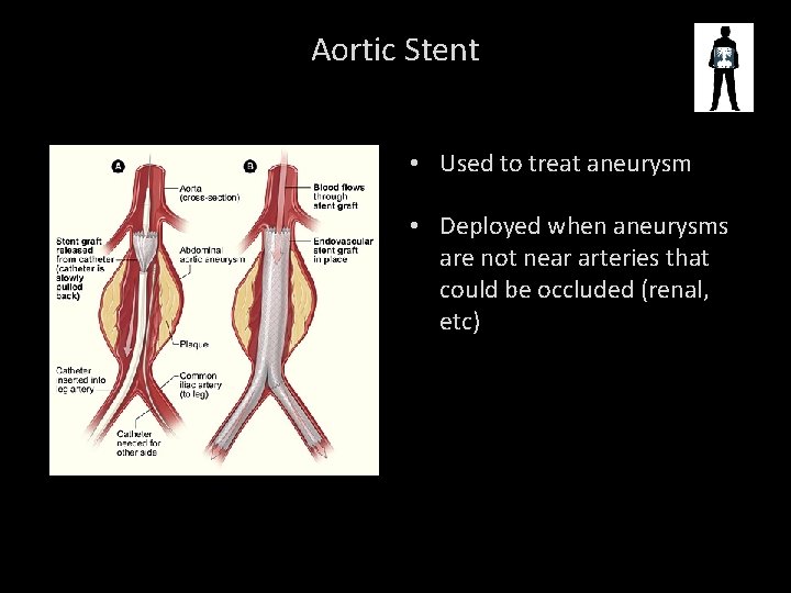 Aortic Stent • Used to treat aneurysm • Deployed when aneurysms are not near