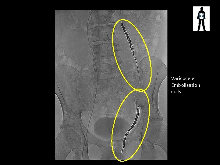Varicocele Embolisation coils 