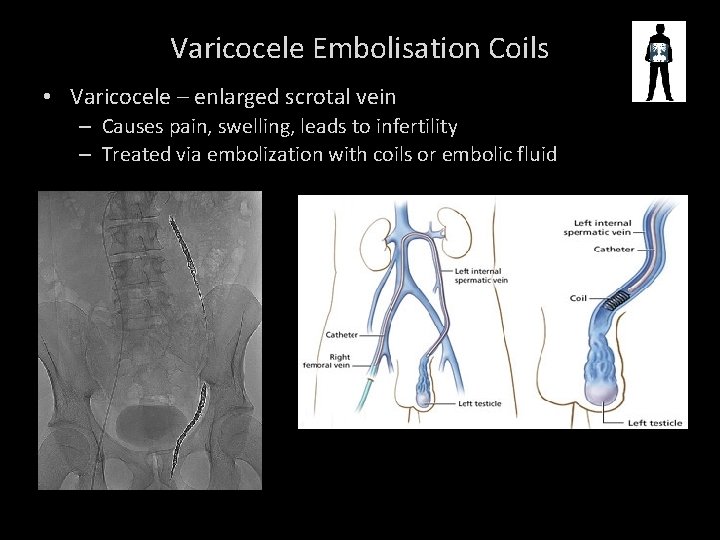 Varicocele Embolisation Coils • Varicocele – enlarged scrotal vein – Causes pain, swelling, leads