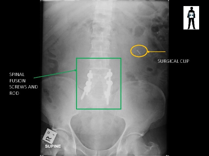 SURGICAL CLIP SPINAL FUSION SCREWS AND ROD 