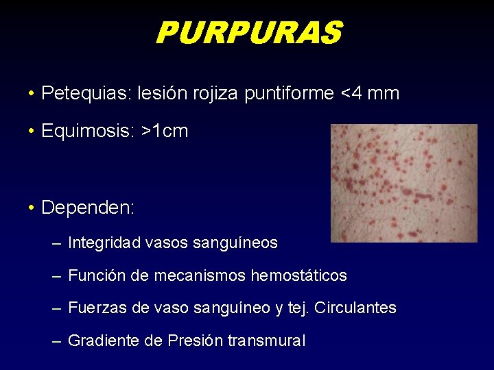 PURPURAS • Petequias: lesión rojiza puntiforme <4 mm • Equimosis: >1 cm • Dependen: