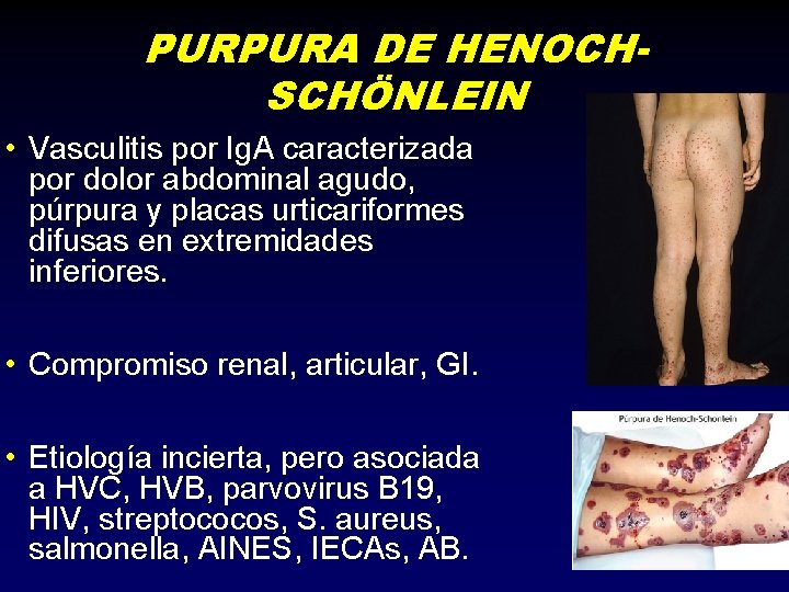 PURPURA DE HENOCHSCHÖNLEIN • Vasculitis por Ig. A caracterizada por dolor abdominal agudo, púrpura