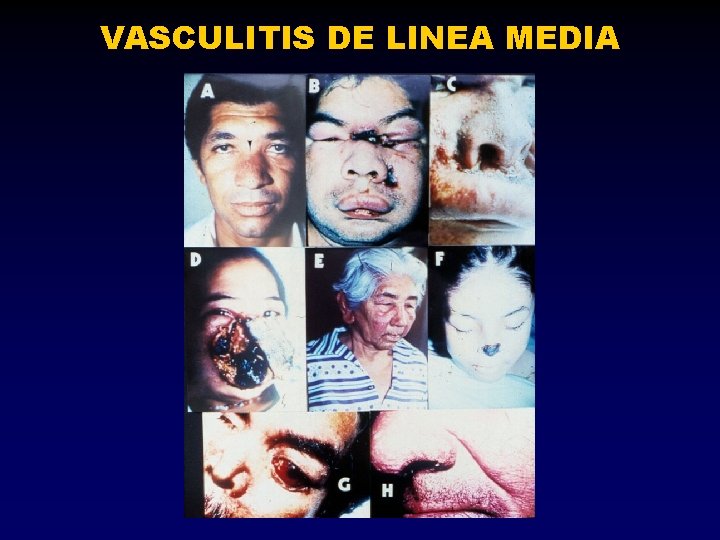 VASCULITIS DE LINEA MEDIA 