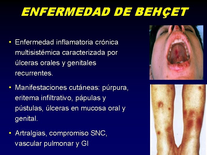 ENFERMEDAD DE BEHÇET • Enfermedad inflamatoria crónica multisistémica caracterizada por úlceras orales y genitales
