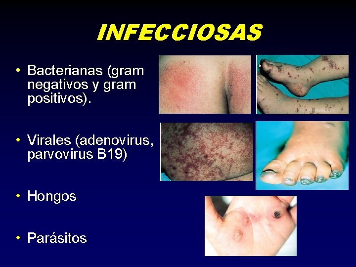 INFECCIOSAS • Bacterianas (gram negativos y gram positivos). • Virales (adenovirus, parvovirus B 19)
