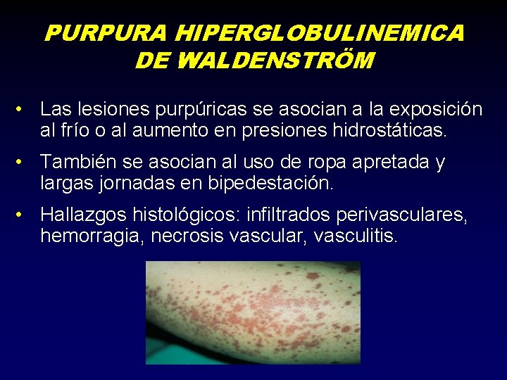 PURPURA HIPERGLOBULINEMICA DE WALDENSTRÖM • Las lesiones purpúricas se asocian a la exposición al