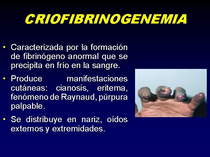 CRIOFIBRINOGENEMIA • Caracterizada por la formación de fibrinógeno anormal que se precipita en frío