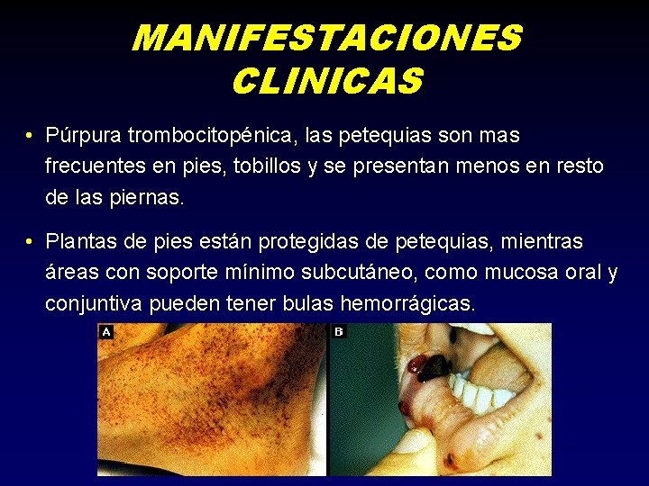 MANIFESTACIONES CLINICAS • Púrpura trombocitopénica, las petequias son mas frecuentes en pies, tobillos y