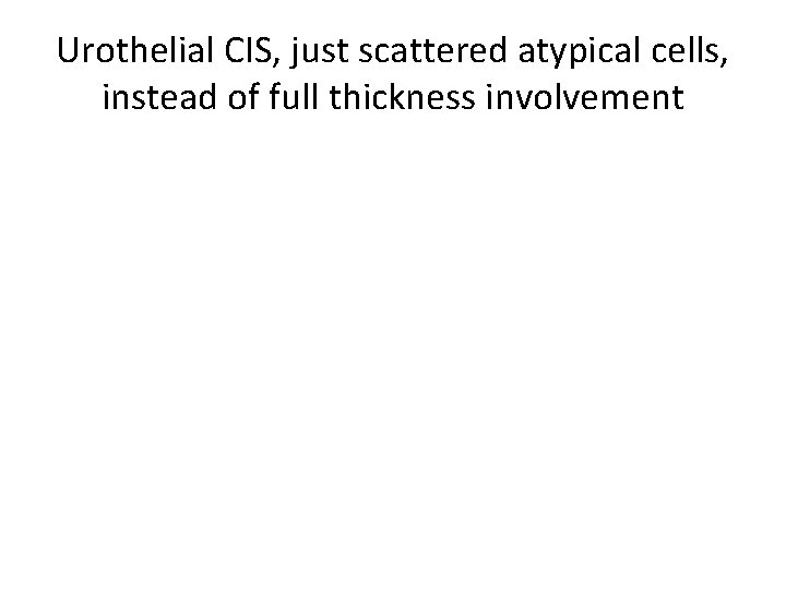 Urothelial CIS, just scattered atypical cells, instead of full thickness involvement 