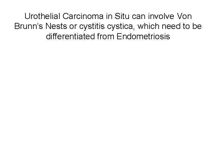 Urothelial Carcinoma in Situ can involve Von Brunn’s Nests or cystitis cystica, which need