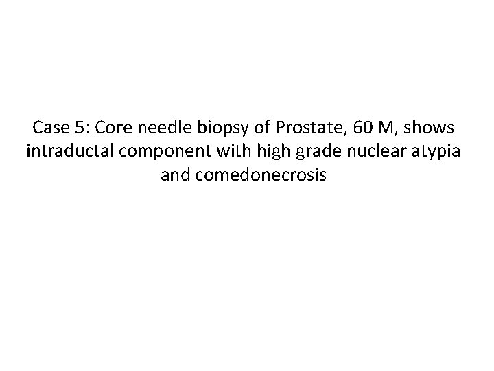 Case 5: Core needle biopsy of Prostate, 60 M, shows intraductal component with high