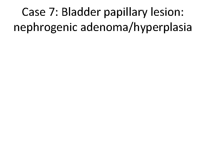 Case 7: Bladder papillary lesion: nephrogenic adenoma/hyperplasia 