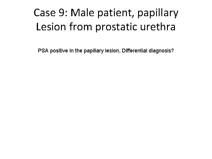 Case 9: Male patient, papillary Lesion from prostatic urethra PSA positive in the papillary