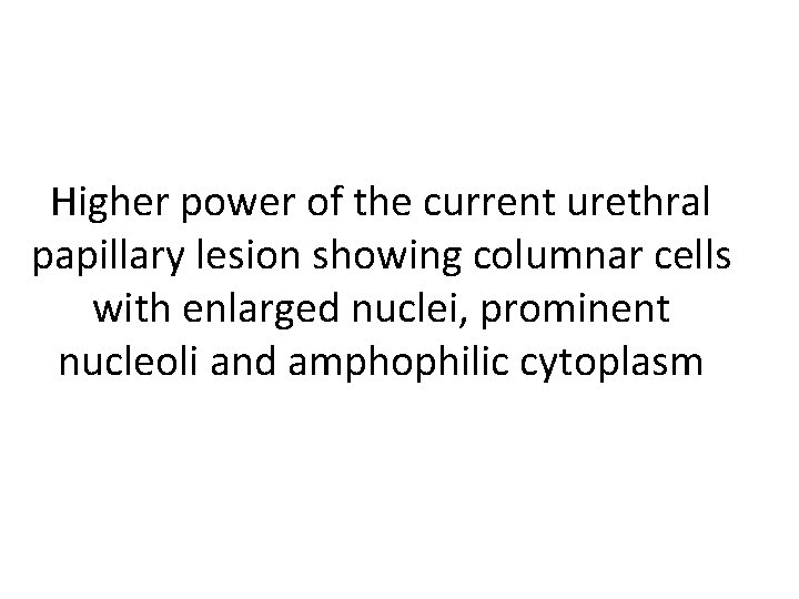 Higher power of the current urethral papillary lesion showing columnar cells with enlarged nuclei,