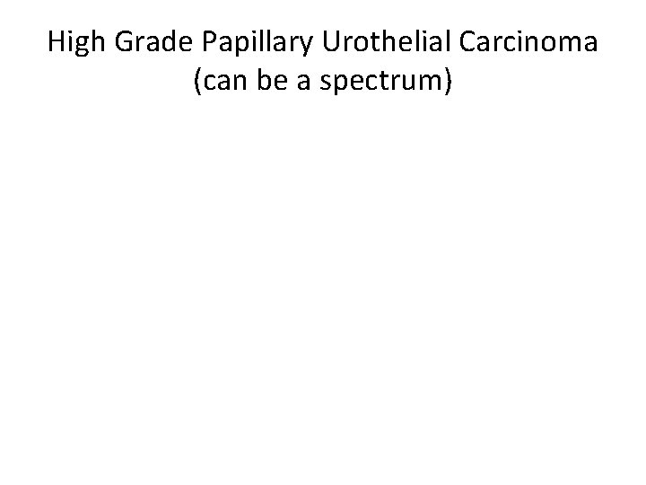 High Grade Papillary Urothelial Carcinoma (can be a spectrum) 