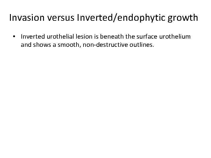 Invasion versus Inverted/endophytic growth • Inverted urothelial lesion is beneath the surface urothelium and