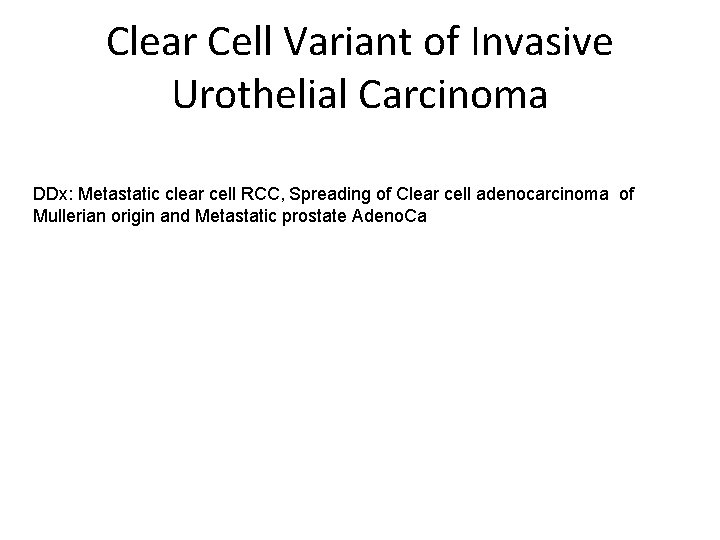 Clear Cell Variant of Invasive Urothelial Carcinoma DDx: Metastatic clear cell RCC, Spreading of