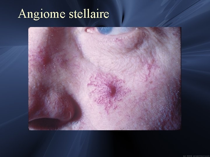 Angiome stellaire 