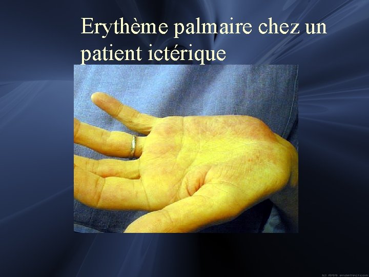 Erythème palmaire chez un patient ictérique 